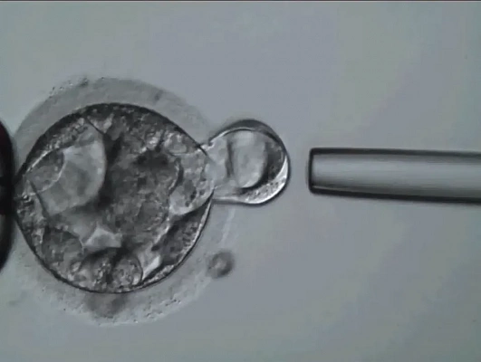 Превью видео Биопсия эмбриона